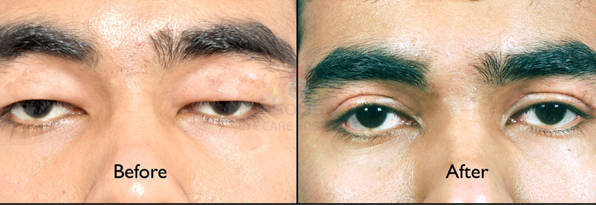 OCULOPLASTY