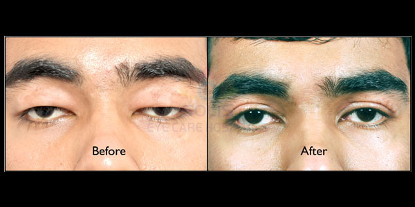 Oculoplasty