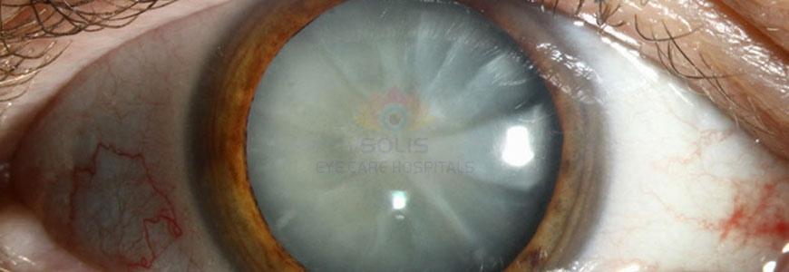 Cataract