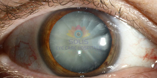 Cataract